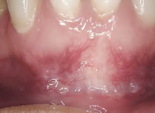 After gum graft