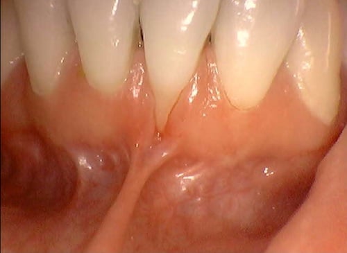 Before gum graft