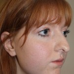 right side view After corrective jaw surgery