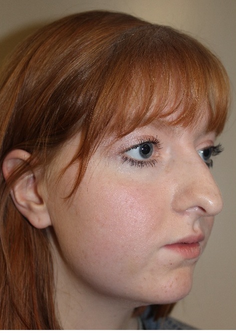 right side view After corrective jaw surgery