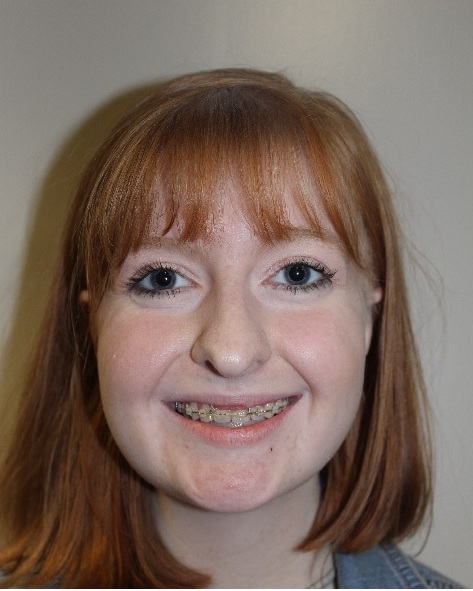 front view After corrective jaw surgery