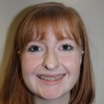 front view After corrective jaw surgery