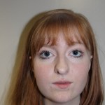 front view After corrective jaw surgery