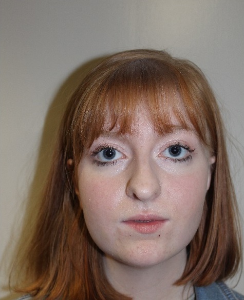 front view After corrective jaw surgery