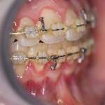 close up of mouth after double jaw osteotomy
