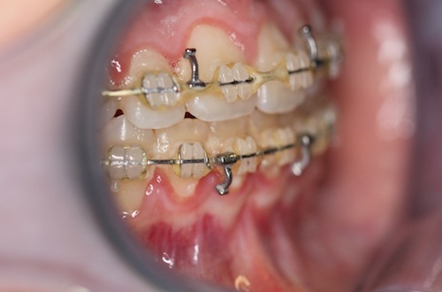 close up of mouth after double jaw osteotomy