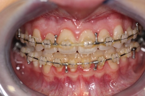 close up of mouth after jaw surgery