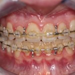 close up of mouth after jaw surgery