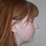 left side view After corrective jaw surgery