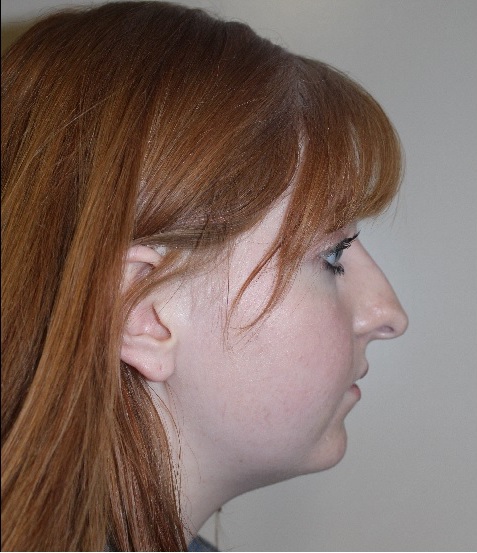 left side view After corrective jaw surgery