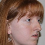 right side view Before corrective jaw surgery