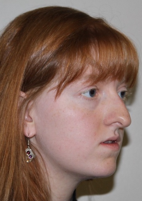 right side view Before corrective jaw surgery