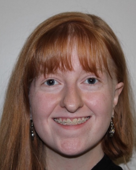 front view Before corrective jaw surgery