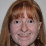 front view Before corrective jaw surgery