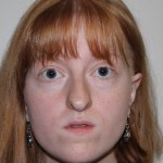 front view Before corrective jaw surgery