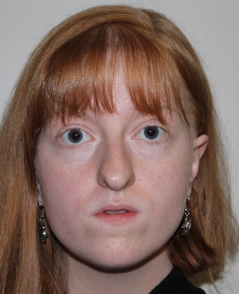 front view Before corrective jaw surgery