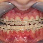 close up of mouth before jaw surgery