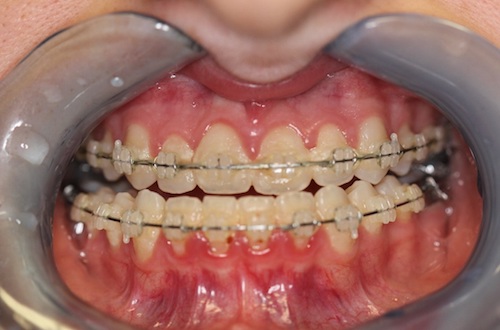 close up of mouth before jaw surgery