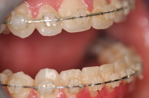 close up of mouth before double jaw osteotomy