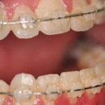 close up of mouth before double jaw osteotomy