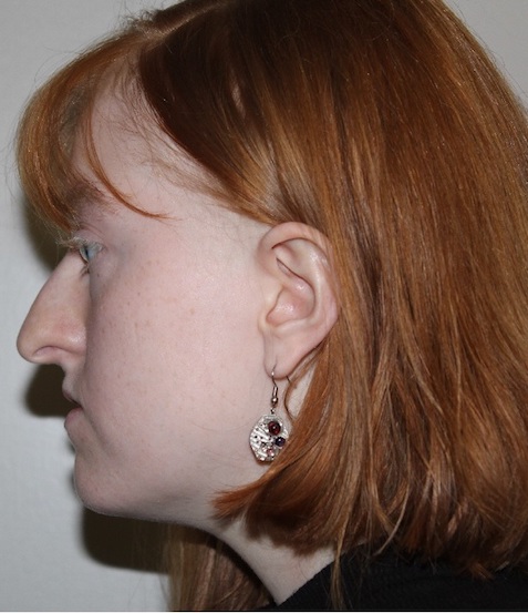 left side view Before corrective jaw surgery