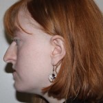 left side view Before corrective jaw surgery