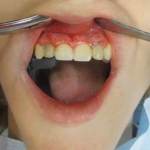 Front view of both teeth after screw retained temporary crown