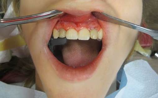 Front view of both teeth after screw retained temporary crown