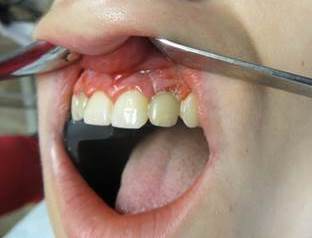 right side view of one tooth after screw retained temporary crown