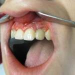 right side view of one tooth after screw retained temporary crown