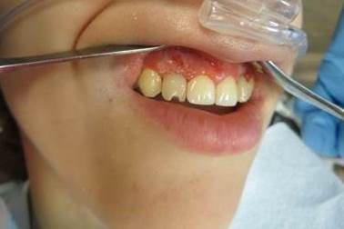 left side view of one tooth after screw retained temporary crown