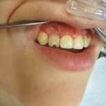 left side view of one tooth after screw retained temporary crown