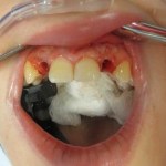 2 teeth sockets before screw retained temporary crown