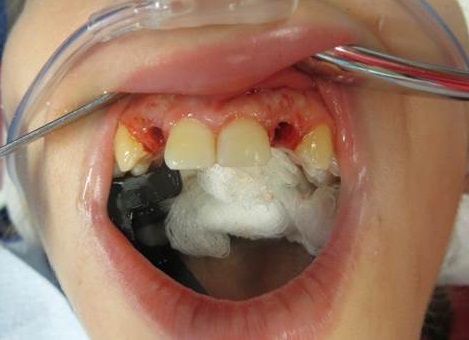 2 teeth sockets before screw retained temporary crown